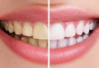 GIẢI ĐÁP THẮC MẮC: Tẩy trắng răng có hại không?