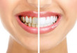 Có nên tẩy trắng răng không? câu hỏi này được nhiều bạn quan tâm
