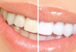 “Bật mí” phương pháp tẩy trắng răng an toàn bằng nguyên liệu thiên nhiên