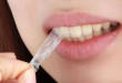 Kinh nghiệm sử dụng miếng dán tẩy trắng răng tại nhà