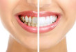 Tẩy trắng răng Laser Whitening, phương pháp tẩy trắng răng ưu việt nhất