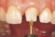 3 bước cơ bản trong quy trình bọc răng sứ thẩm mỹ