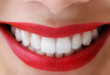 Bọc sứ răng cửa cho hàm răng trắng đẹp ngọc ngà