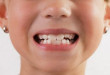 Cách chữa bệnh nghiến răng ở trẻ em nhanh và hiệu quả  nhất