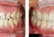 Trám răng có bền không, những yếu tố nào quyết định?