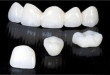 Bọc răng sứ có bền không? Chuyên gia hàng đầu giải đáp