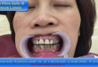 Bọc răng là gì? Có mấy phương pháp bọc răng?