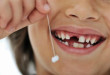 Răng sữa bị sâu có nên nhổ hay không?