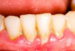 Răng bong tróc – Nguyên nhân và cách điều trị