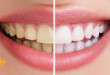 Làm trắng răng nên kiêng ăn gì? TOP thực phẩm cần tránh