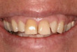 Những nguy hiểm khi tái tạo thiếu men răng