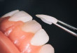 Làm trắng răng veneer có được không? – Bác sĩ nha khoa giải đáp