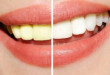 Làm trắng răng giá cả bao nhiêu? – Chi phí tẩy trắng bằng công nghệ mới