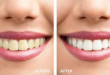 Làm trắng răng uy tín Hà Nội – Mách bạn địa chỉ UY TÍN số 1 hiện nay