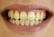 4 Cách làm trắng răng bị ố vàng đơn giản, siêu tiết kiệm