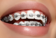 Bật mí ưu nhược điểm của niềng răng mắc cài là gì?