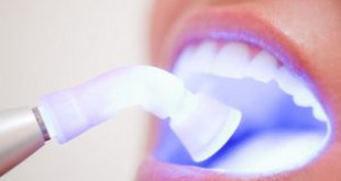 Bí quyết làm trắng răng đơn giản tại nhà bạn phải làm ngay lập tức