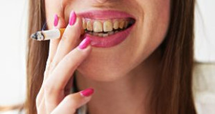 Giải đáp thắc mắc của bạn xung quanh vấn đề: Tại sao vàng răng?