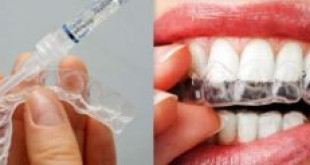 Tẩy trắng răng bằng máng được thực hiện như thế nào?