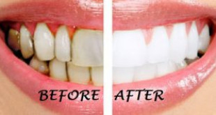 Tẩy trắng răng có tốt không? câu hỏi được nhiều bạn quan tâm