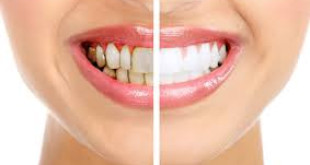 Tẩy trắng răng Laser Whitening, phương pháp tẩy trắng răng ưu việt nhất