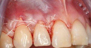 Làm răng trắng tại nhà bằng miếng dán có tác hại gì không?