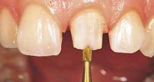 3 bước cơ bản trong quy trình bọc răng sứ thẩm mỹ