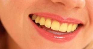 Tại sao răng có màu vàng và cách khắc phục hiệu quả