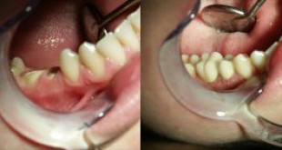 Bọc răng hàm bằng sứ cho hiệu quả ăn nhai tốt