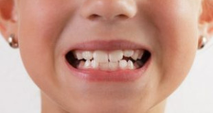 Cách chữa bệnh nghiến răng ở trẻ em nhanh và hiệu quả  nhất