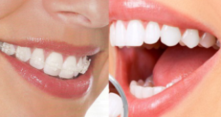 Răng hơi hô có nên niềng hay bọc sứ để làm thẳng đẹp lại
