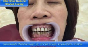 Bọc răng là gì? Có mấy phương pháp bọc răng?