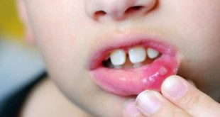 Trẻ bị lở miệng, nhiệt miệng phải làm sao, chữa trị dứt điểm như thế nào?