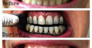 Cách làm trắng răng với than hoạt tính có hiệu quả không?
