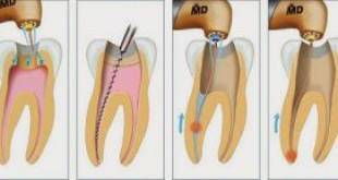 Răng đã được nội nha có thật sự bền vững?