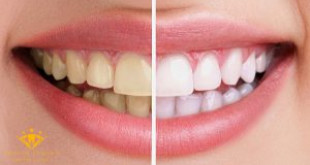 Làm trắng răng nên kiêng ăn gì? TOP thực phẩm cần tránh