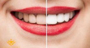 Giá tẩy trắng răng tại Hà Nội – Yếu tố nào quyết định đến chi phí