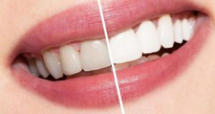 Làm trắng răng bằng laser bao nhiêu tiền? Chi phí tẩy trắng răng