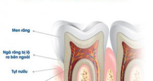 Nguyên nhân và những cách phòng ngừa ê buốt chân răng