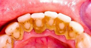 Những nguy hiểm của vôi răng gây ra