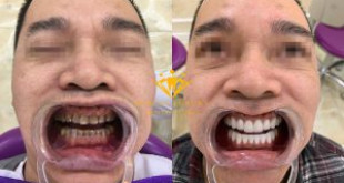 Làm trắng răng vĩnh viễn – Bật mí cách được ưa chuộng nhất