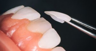 Làm trắng răng veneer có được không? – Bác sĩ nha khoa giải đáp
