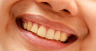 Làm trắng răng giữ được bao lâu? Thời gian duy trì kết quả tẩy trắng