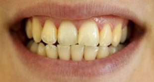 4 Cách làm trắng răng bị ố vàng đơn giản, siêu tiết kiệm