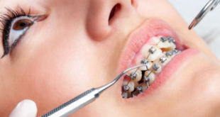 Video quy trình niềng răng mắc cài tại Nha khoa Dencos luxury
