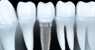 Thời gian trồng răng implant là bao lâu?