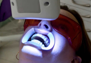 Giật mình với sư thật: Tẩy trắng răng bằng laser có hại không﻿?