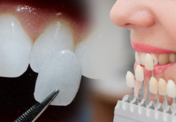 Cách điều trị vàng răng do nội sinh