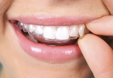 Những lưu ý khi niềng răng không mắc cài, trước và sau thực hiện