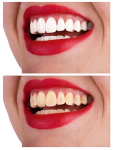 Cách Sử dụng miếng dán trắng răng 